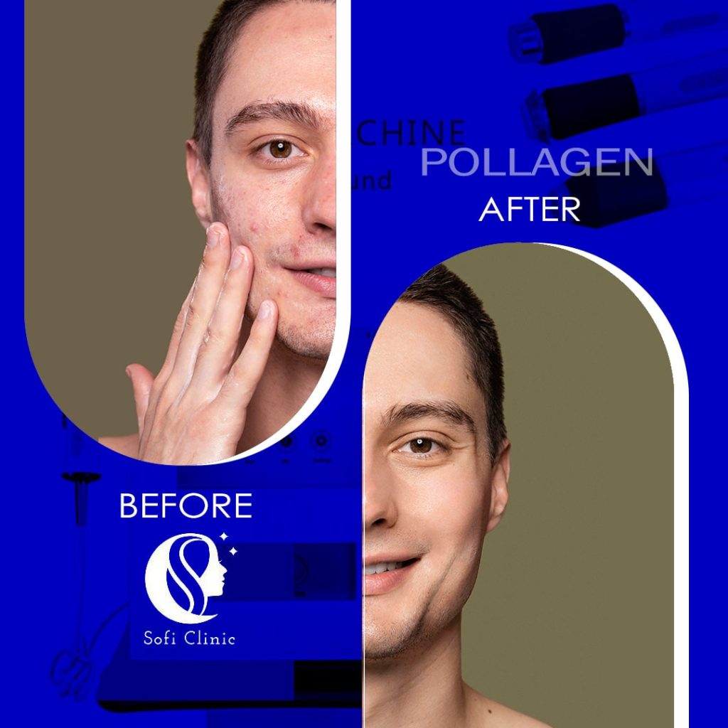 عکس قبل و بعد هایفو