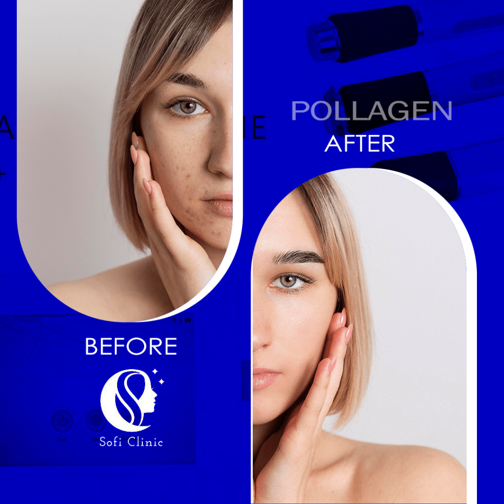 عکس قبل و بعد هایفو