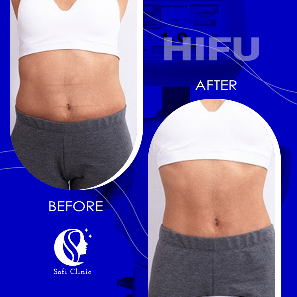 عکس قبل و بعد هایفو