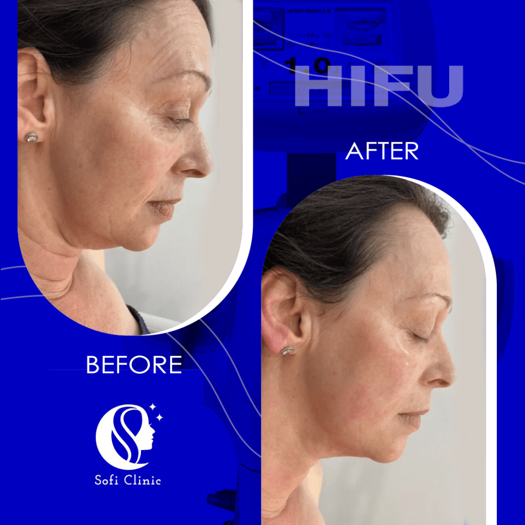 عکس قبل و بعد هایفو