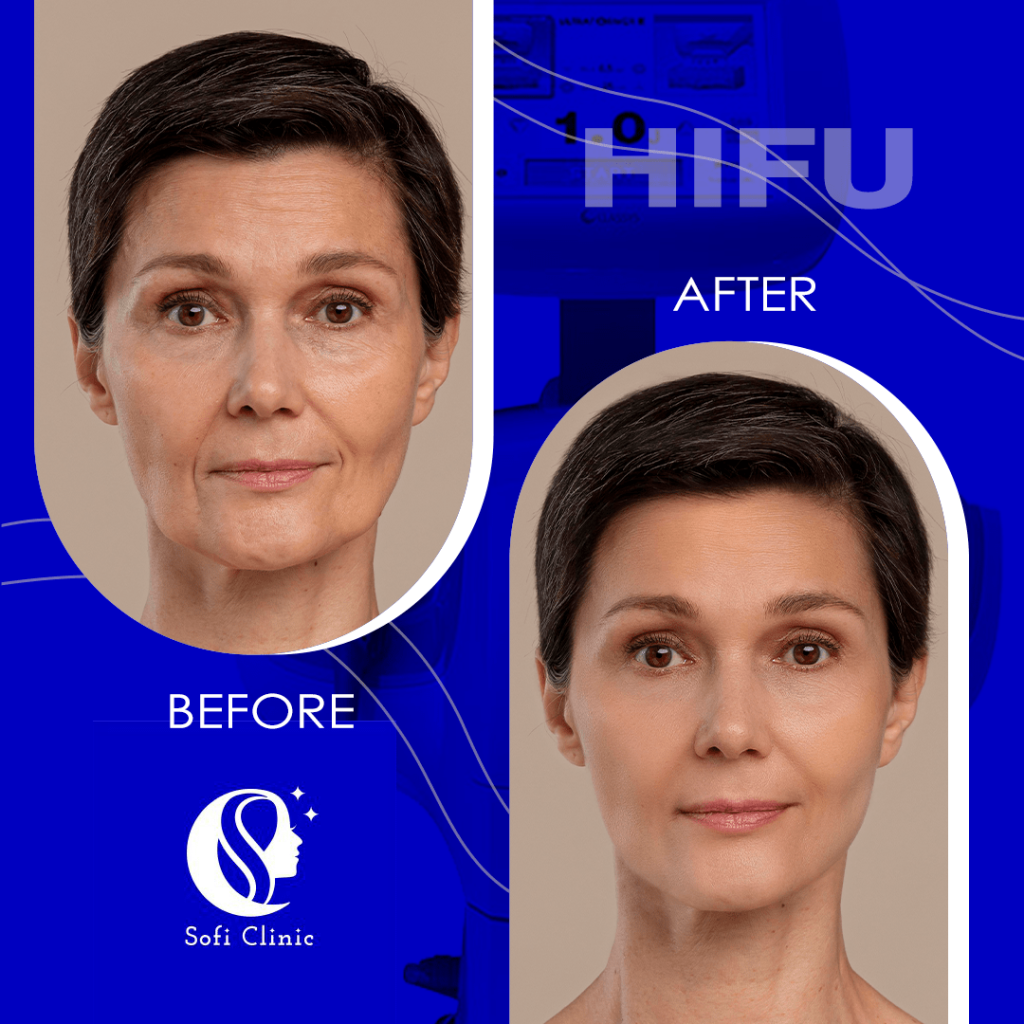 عکس قبل و بعد هایفو