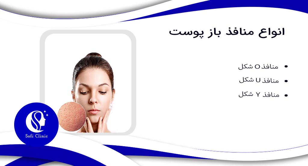 انواع منافذ باز پوست