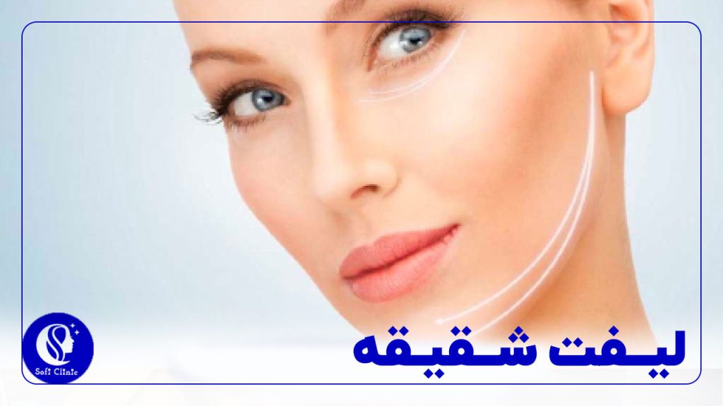 لیفت شقیقه